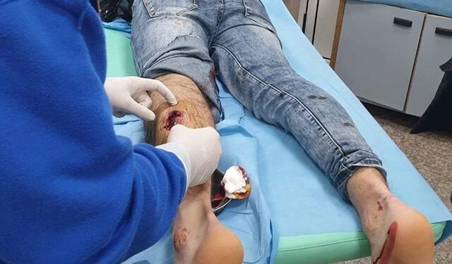 Skandal: Pas tri ditësh mjektë ia gjejnë plumbin në këmbë djalit nga Prizreni