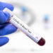 Regjistrohen mbi 70 raste të reja me koronavirus në zonat e banuara me shumicë serbe