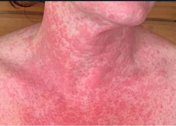 Ja çka i ndodhi kësaj gruaje pasi u vaksinua  me AstraZeneca (foto)