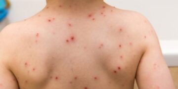 Çka është dhe si trajtohet kjo semundje tek fëmijët