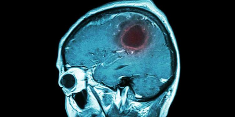 Përmes vetullës 34-vjeçares në Tiranë i hiqet tumori në kokë