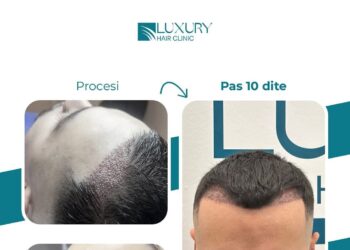 Luxury Hair Clinic – Po i jep Kosovës Famë Botërore në Transplantin e Flokëve