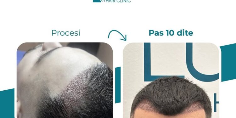 Luxury Hair Clinic – Po i jep Kosovës Famë Botërore në Transplantin e Flokëve
