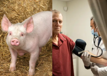 Pas 271 ditësh, amerikanit i hiqet veshka e derrit