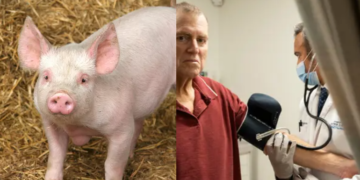 Pas 271 ditësh, amerikanit i hiqet veshka e derrit
